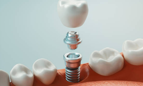 Dental Implants are a great choice for restoration